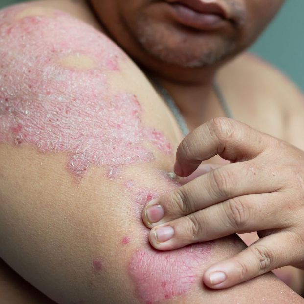 Hombre con psoriasis