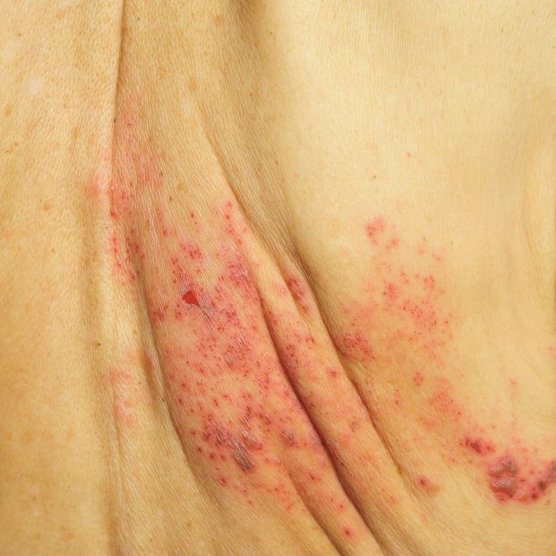 Herpes zoster en persona mayor