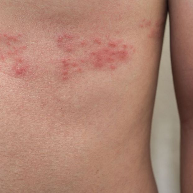 Herpes zoster, comúnmente llamada culebrilla