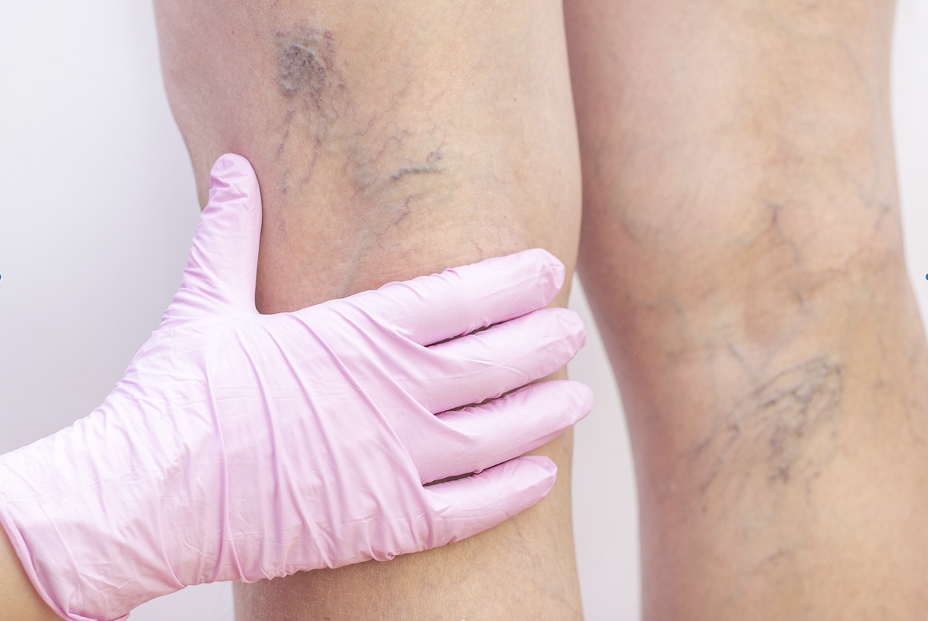 Las varices aumentan el riesgo cardiovascular en estadios avanzados