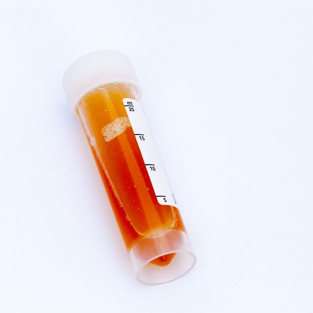 ¿Qué es la hematuria y cuándo debe alarmar a las personas mayores? ¿Qué es la hematuria y cuándo debe alarmar a las personas mayores?