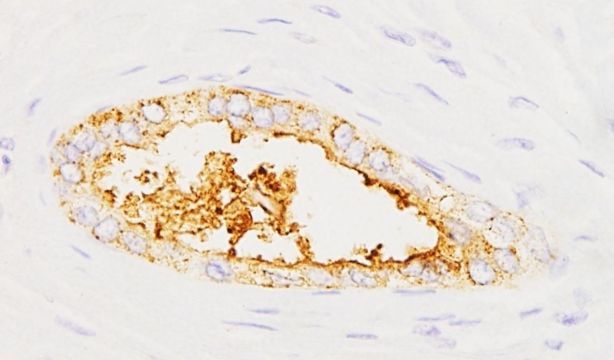 Crean un test que detecta el cáncer de páncreas en minutos con una muestra de sangre