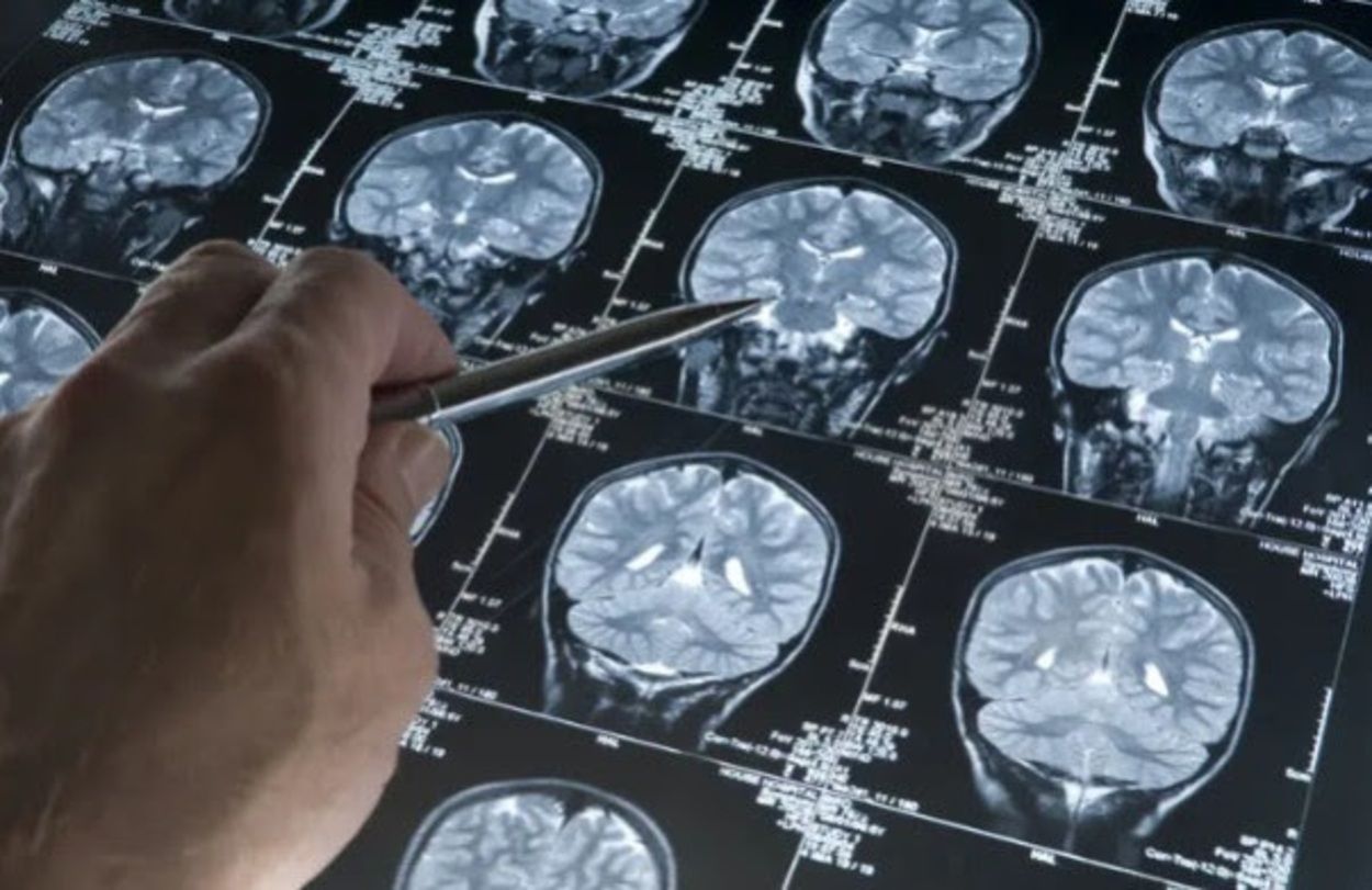 Alzhéimer: una nueva prueba detecta el doble de casos antes de los síntomas