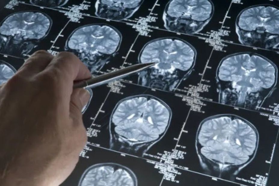 Alzhéimer: una nueva prueba detecta el doble de casos antes de los síntomas Alzhéimer: una nueva prueba detecta el doble de casos antes de los síntomas