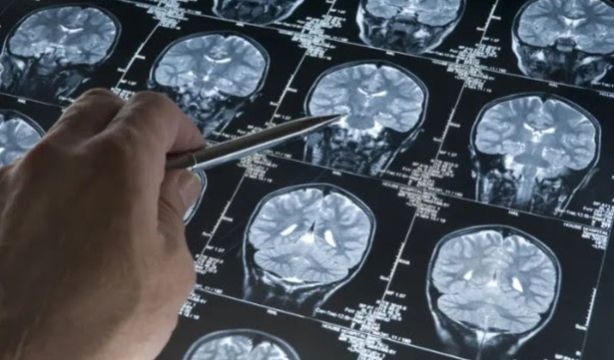 Alzhéimer: una nueva prueba detecta el doble de casos antes de los síntomas