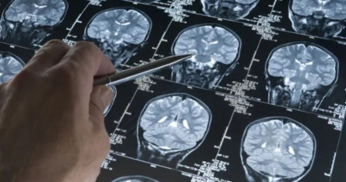Safer Alzheimer’s Treatment: Antibody Fragments Reduce Brain Hemorrhage Risk