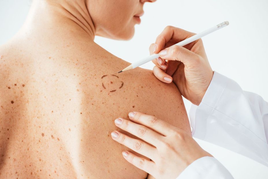 Los mitos que resurgen cada verano sobre el cáncer de piel Los mitos que resurgen cada verano sobre el cáncer de piel