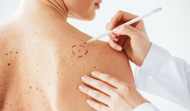 Los mitos que resurgen cada verano sobre el cáncer de piel