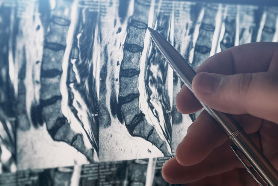 Expertos alertan de un aumento de los diagnósticos de osteoporosis en menores de 50 años