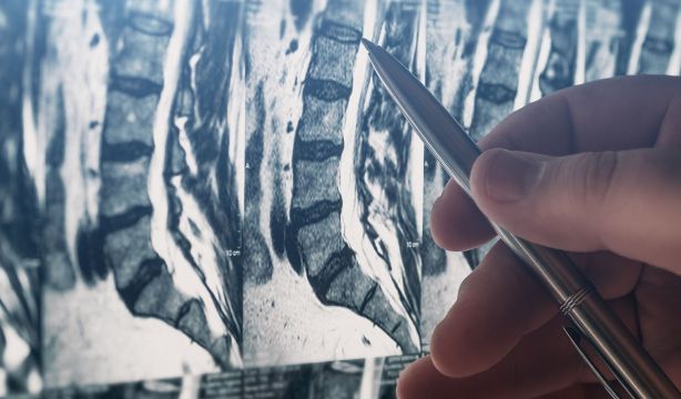 ¿Adiós a la densitometría? El TAC lumbar podría detectar antes la osteoporosis