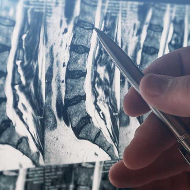 ¿Adiós a la densitometría? El TAC lumbar podría detectar antes la osteoporosis