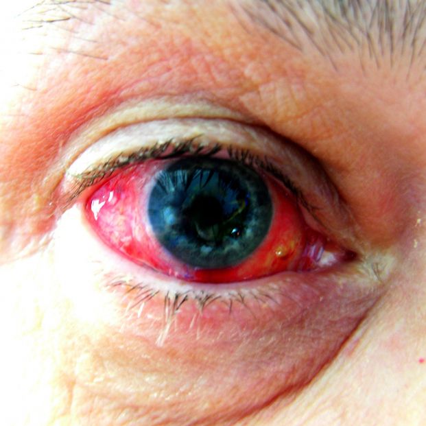 Ojos enrojecidos; ¿cuáles son las causas más comunes y cómo evitarlo?