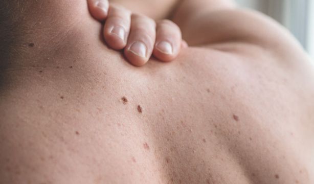 ¿Soy alérgico al sol? Cómo saber si una erupción en la piel está relacionada con la radiación