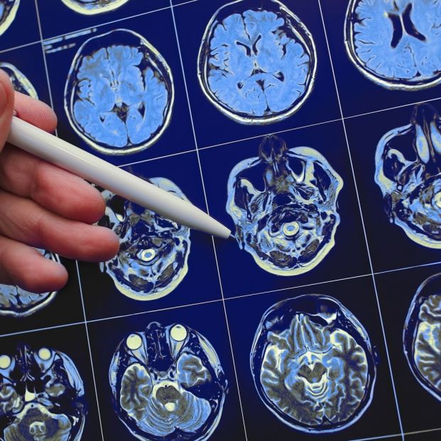 Origen cerebral de las convulsiones Origen cerebral de las convulsiones