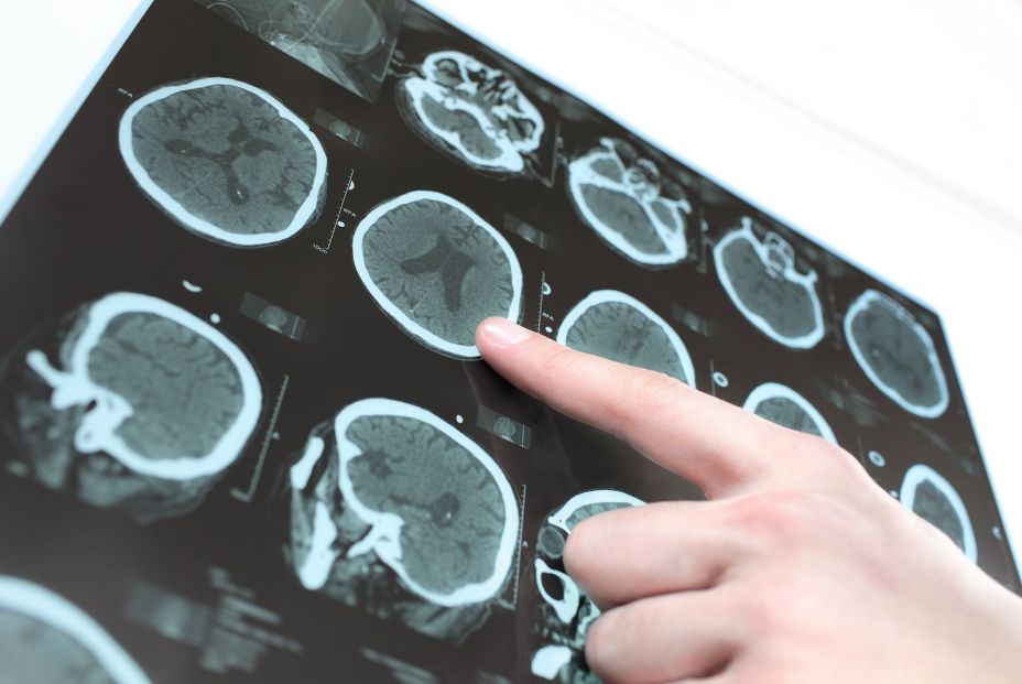 bigstock Ct Scan Of The Patient s Brain 72134848
