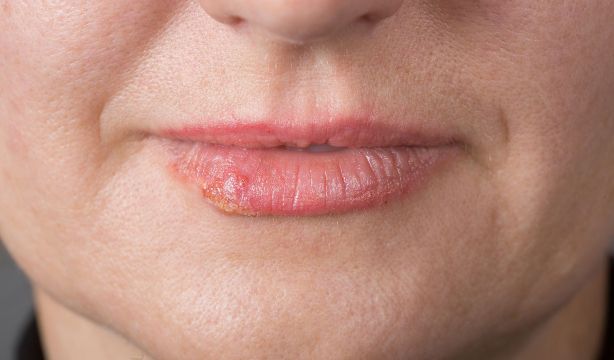 La clave para prevenir la reaparición del herpes labial (Fuente: BigStock)