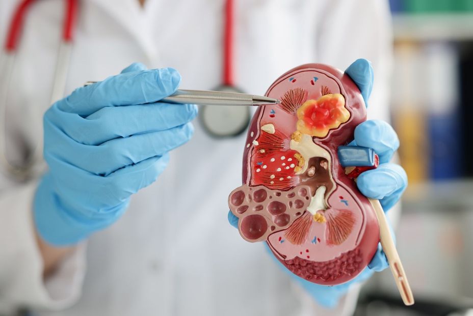 La periodontitis podría ofrecer pistas sobre la salud renal desde fases tempranas (Fuente: BigStock) La periodontitis podría ofrecer pistas sobre la salud renal desde fases tempranas (Fuente: BigStock)