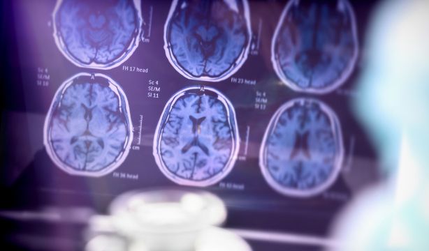Por qué las mujeres son más vulnerables al alzhéimer (Fuente: BigStock)