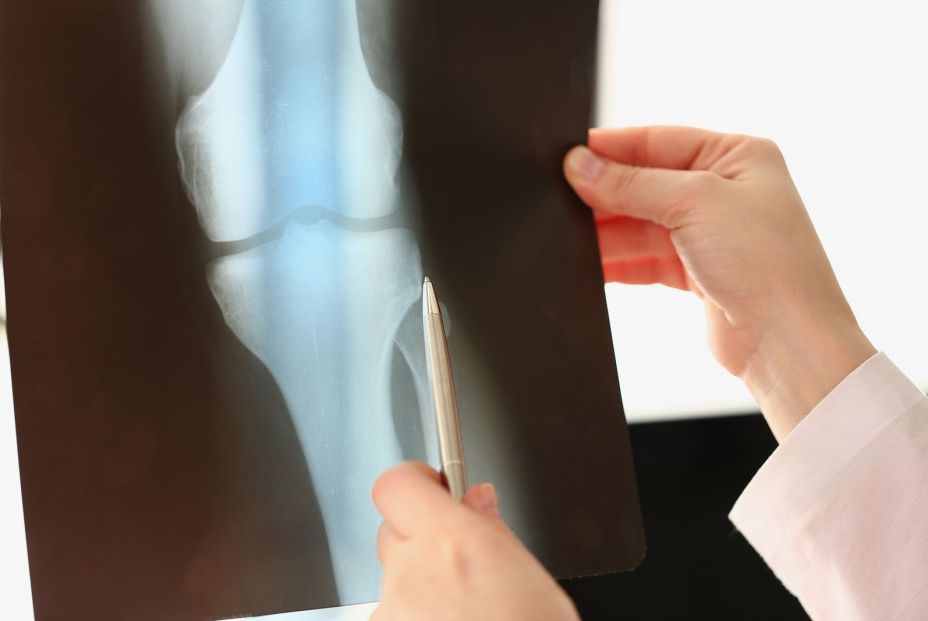 El Hospital Universitario La Luz apuesta por la cirugía robótica para las prótesis de rodilla El Hospital Universitario La Luz apuesta por la cirugía robótica para las prótesis de rodilla