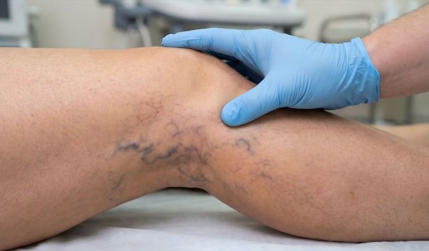 La técnica que permite tratar las varices sin anestesia en menos de una hora (Fuente: Europapress) La técnica que permite tratar las varices sin anestesia en menos de una hora (Fuente: Europapress)