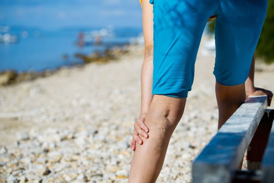 El tratamiento que permite tratar las varices sin anestesia en menos de una hora El tratamiento que permite tratar las varices sin anestesia en menos de una hora