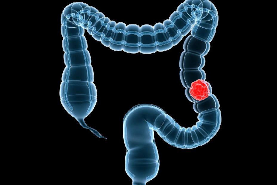 Un estudio vincula una bacteria con un cáncer colorrectal más agresivo y con más riesgo de recaída (Fuente: BigStock) Un estudio vincula una bacteria con un cáncer colorrectal más agresivo y con más riesgo de recaída (Fuente: BigStock)