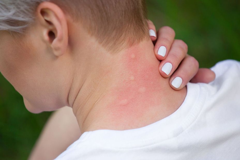 Cada especie de mosquito tiene sus propias preferencias a la hora de picar (Fuente: BigStock)