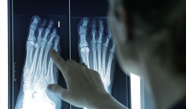 Un 60% de los adultos sufre deformidades en los pies sin saber que pueden prevenirse / Fuente: EuropaPress