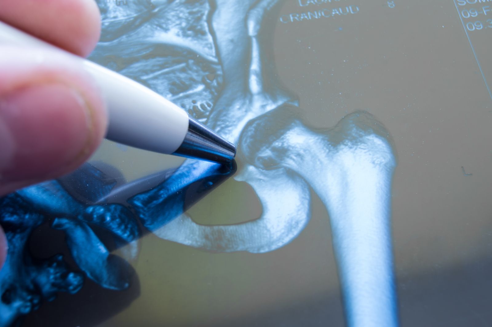 La IA ya predice el riesgo de fractura de cadera mejor que las pruebas actuales (Fuente: BigStock) La IA ya predice el riesgo de fractura de cadera mejor que las pruebas actuales (Fuente: BigStock)