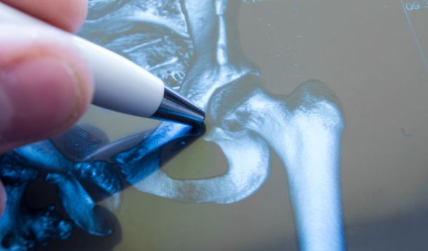 La IA ya predice el riesgo de fractura de cadera mejor que las pruebas actuales (Fuente: BigStock)