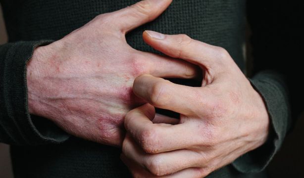 Errores que debes evitar si tienes dermatitis 