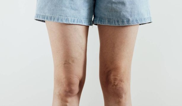 Piernas hinchadas y varices después del verano: cuándo prestar atención