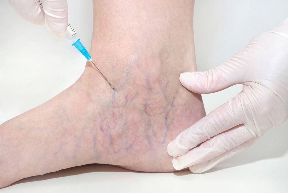 Piernas hinchadas y varices después del verano: cuándo prestar atención (Fuente: BigStock) Piernas hinchadas y varices después del verano: cuándo prestar atención (Fuente: BigStock)