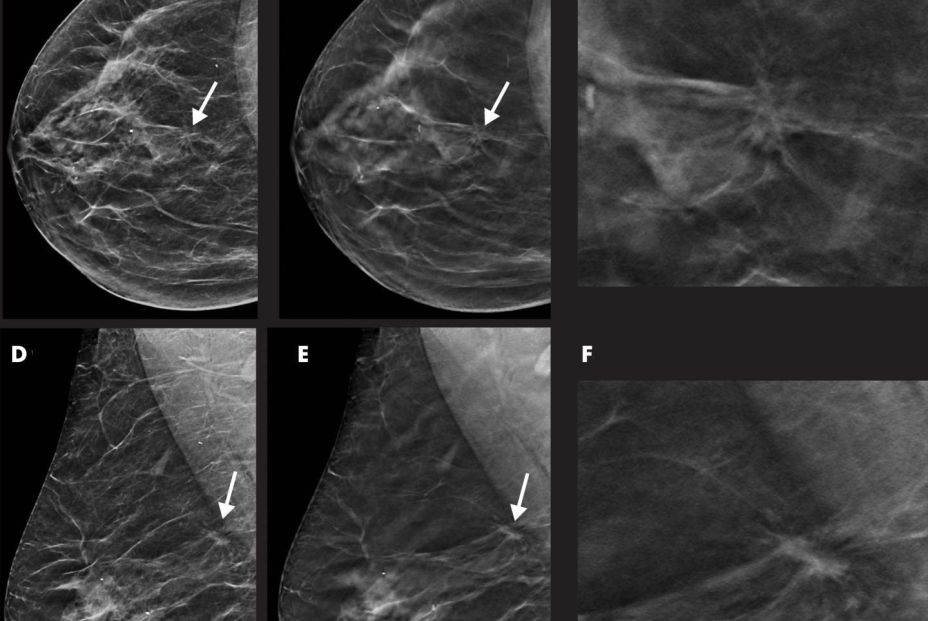 Crean un modelo de IA para detectar la metástasis de cáncer de mama en zonas cercanas al pecho