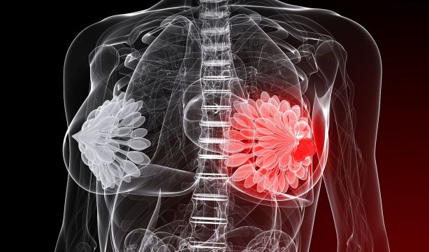 Crean un modelo de IA para detectar la metástasis de cáncer de mama en zonas cercanas al pecho