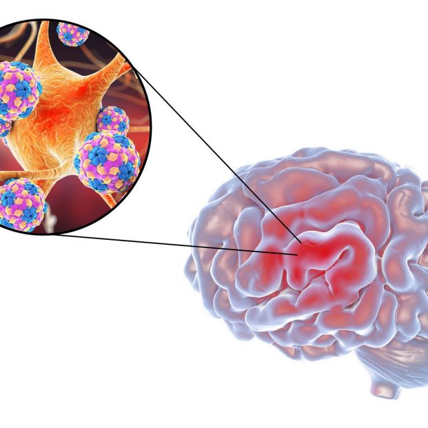 ¿Sabes que un herpes puede afectar al cerebro y es muy peligroso?