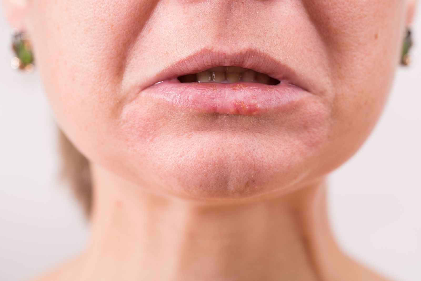 ¿Cuáles son las principales enfermedades que sufren los labios?