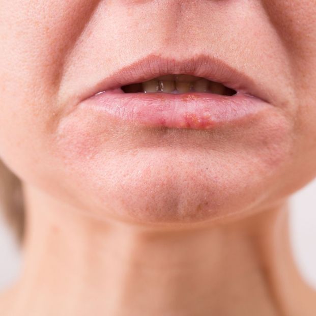 ¿Cuáles son las principales enfermedades que sufren los labios?