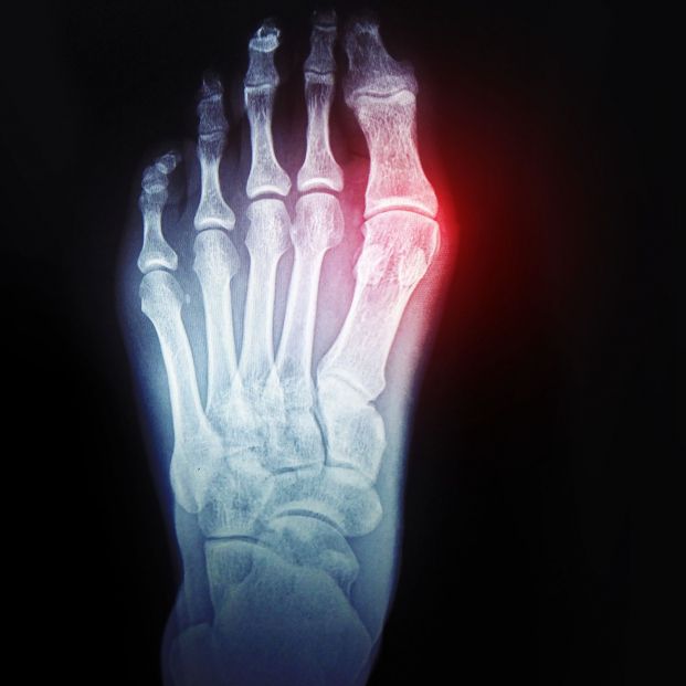 Cómo tratar una fractura en los huesos de la planta del pie