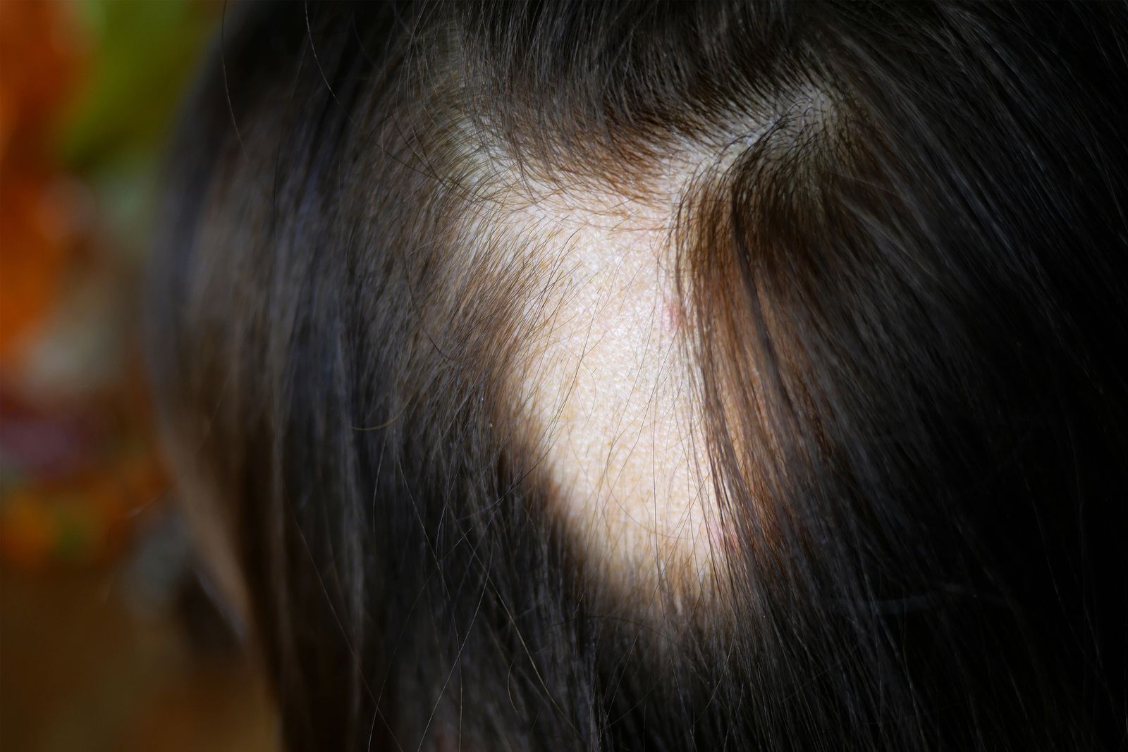 La alopecia en zonas localizadas se asocia con un tipo de personalidad ansioso