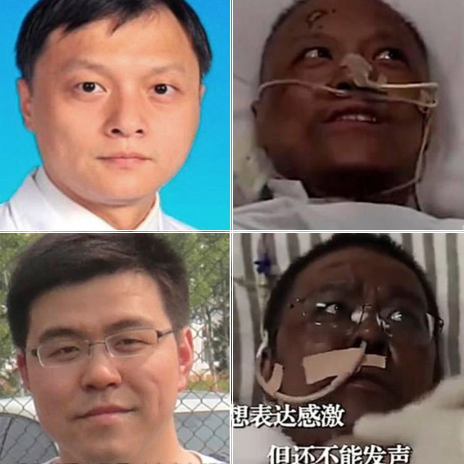 Dos médicos chinos despiertan con la piel de color negro tras recuperarse del coronavirus