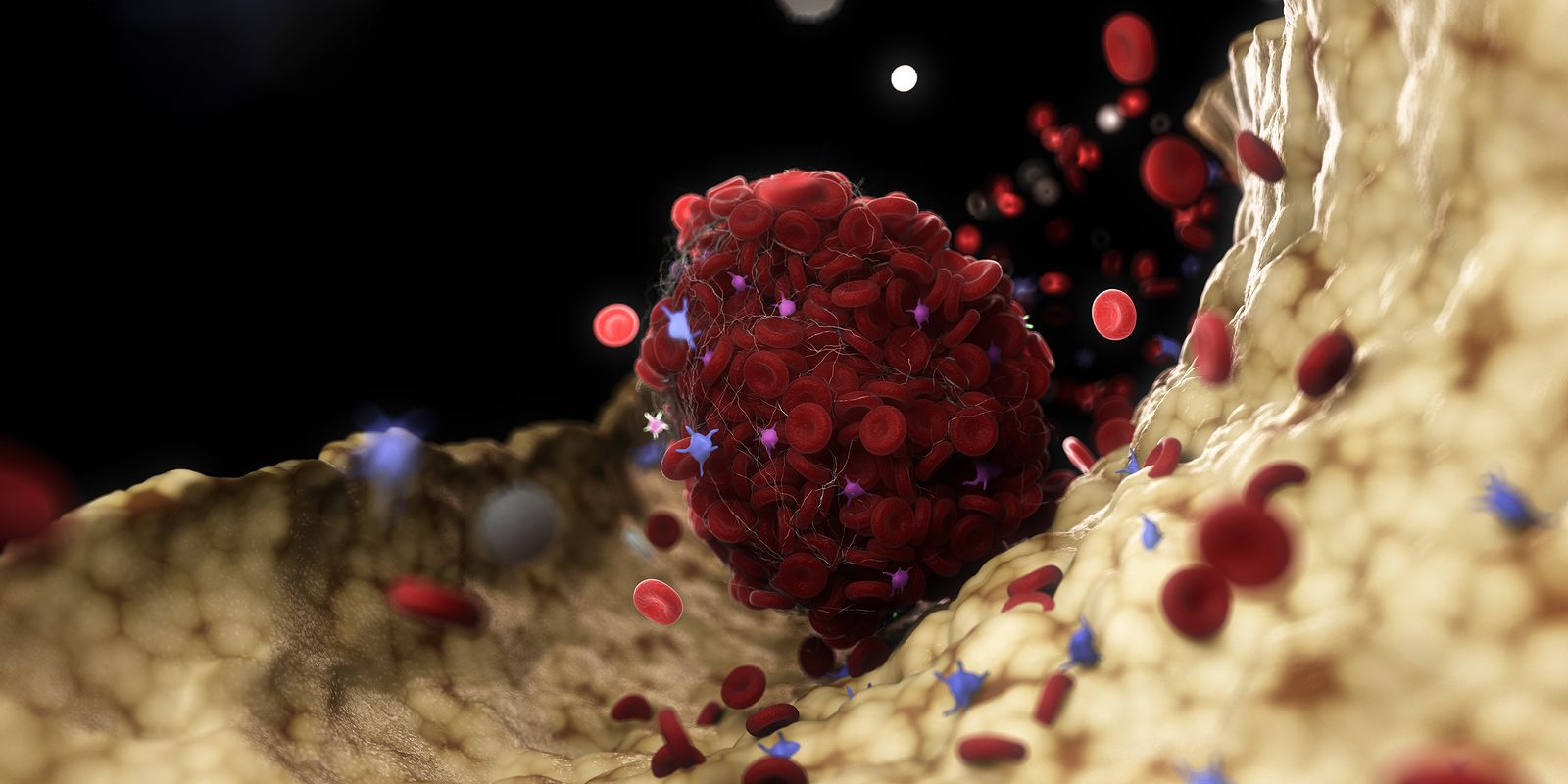 Los neumólogos alertan de una "oleada de trombos en piernas y pulmones" tras el COVID-19