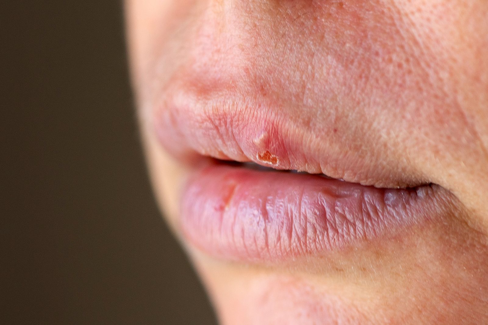 Descubren un nuevo antiviral contra el herpes simple resistente a los tratamientos