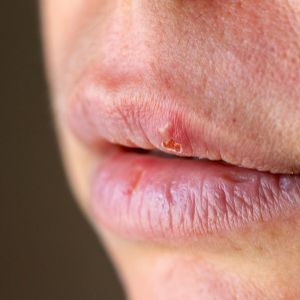 bigstock Herpes On The Lip Close Up Mac 270625021