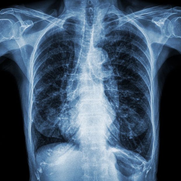 bigstock Normal Chest X ray Of Old Pati 213376141