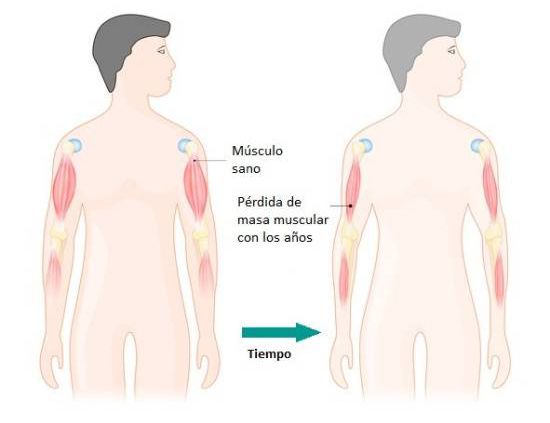 Sarcopenia