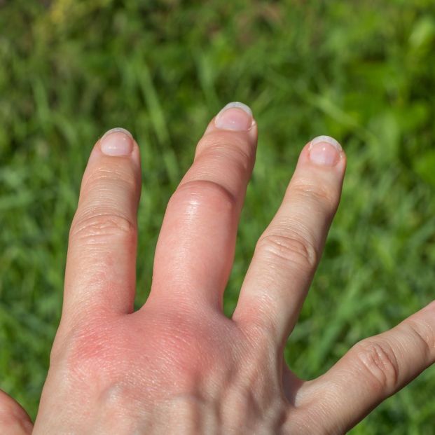 Cómo actuar ante las picaduras de mosca negra