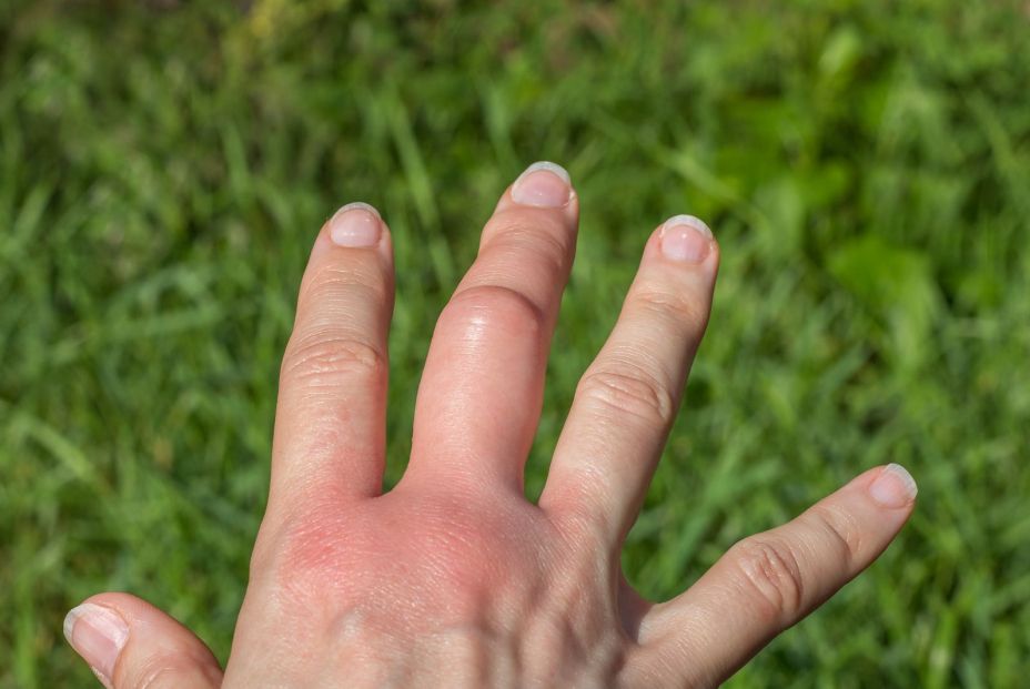 Cómo actuar ante las picaduras de mosca negra