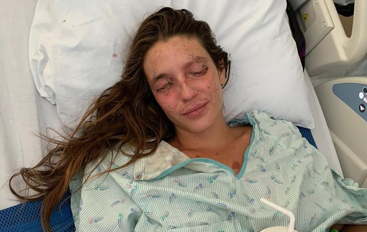 Una española se quema la cara en un accidente doméstico en EEUU y pide ayuda para pagar los gastos