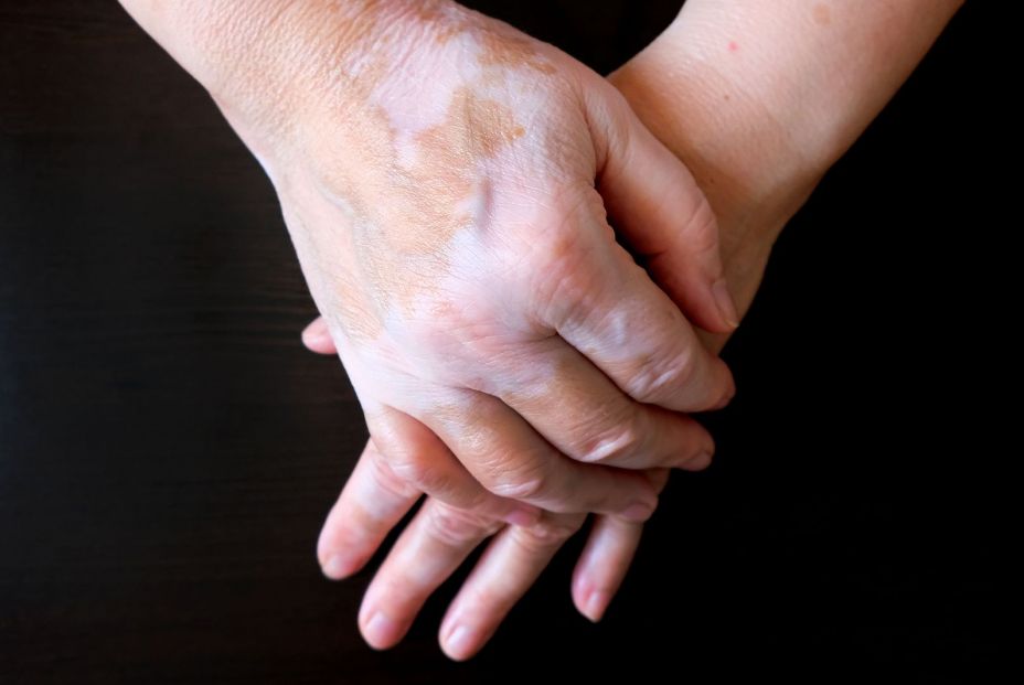 ¿Qué es el vitiligo? ¿Qué es el vitiligo?